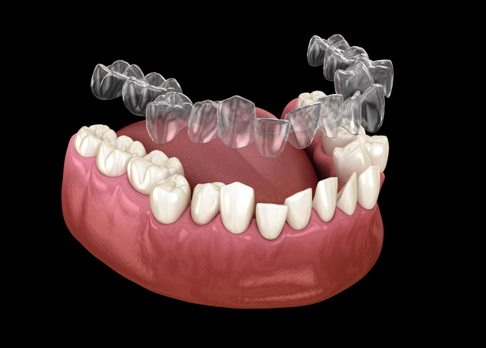 Convenient and Invisible Way to Straighten Smiles