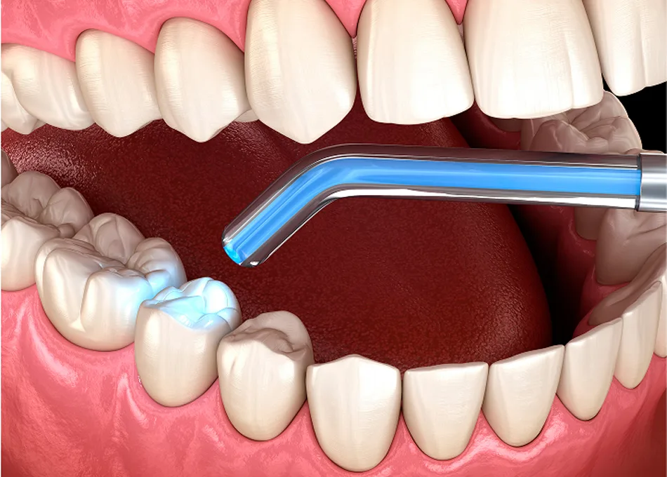 Dental Fillings Image